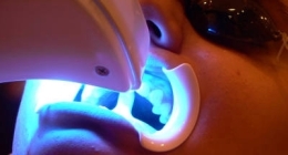 studio dentistico gallo, subbiano, denti bianchi